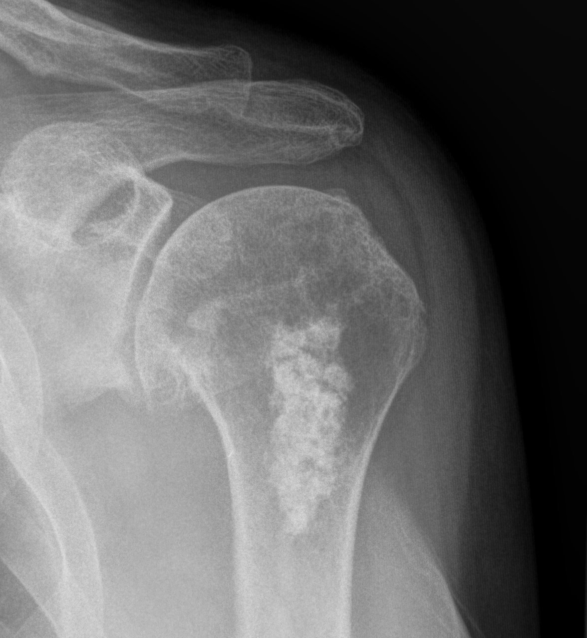 Shoulder Enchondroma